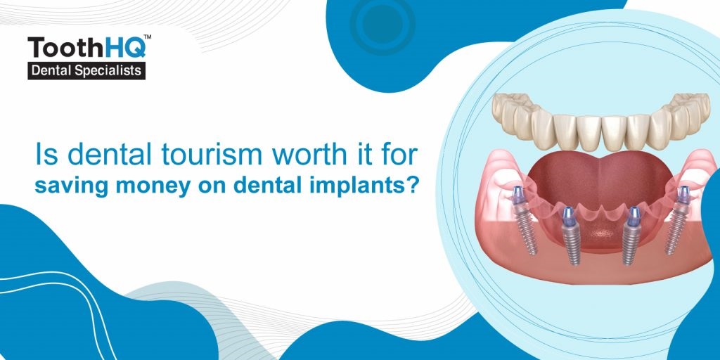 Cost Savings: Dental Tourism Vs. Local Treatments