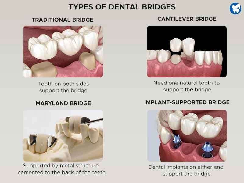 Dental Bridges And Crowns: Affordable Solutions Abroad