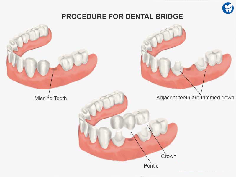 Dental Bridges And Crowns: Affordable Solutions Abroad