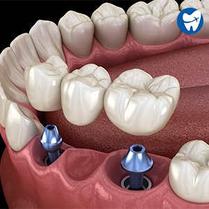 Dental Bridges And Crowns: Affordable Solutions Abroad