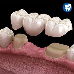 Dental Bridges And Crowns: Affordable Solutions Abroad