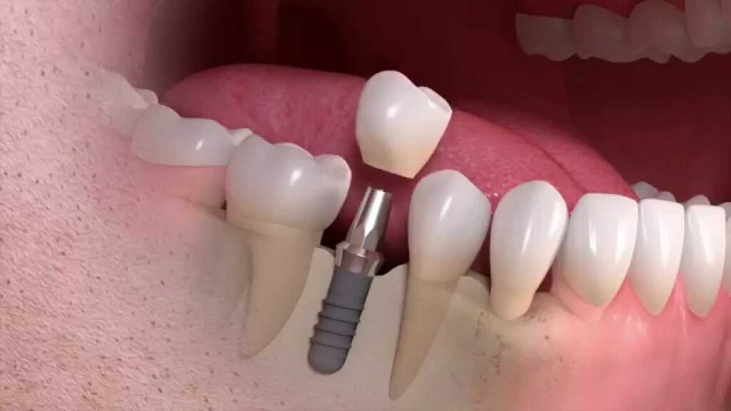 Dental Implants Abroad: A Comprehensive Guide