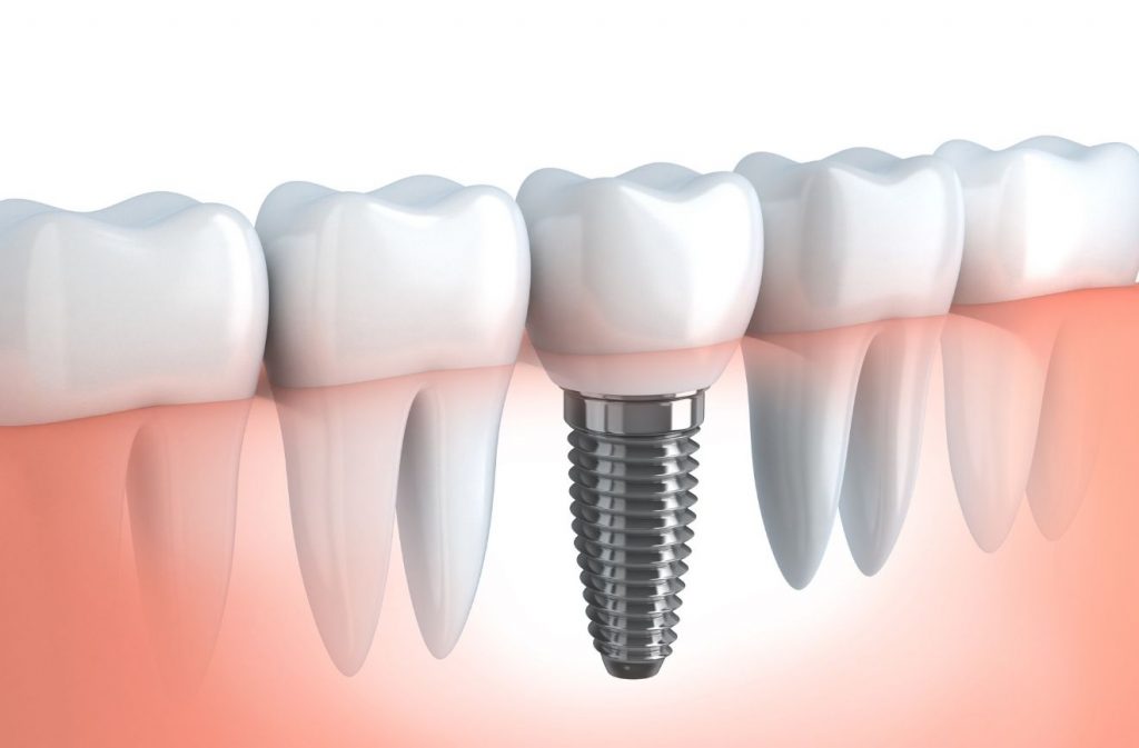 Dental Implants Abroad: A Comprehensive Guide