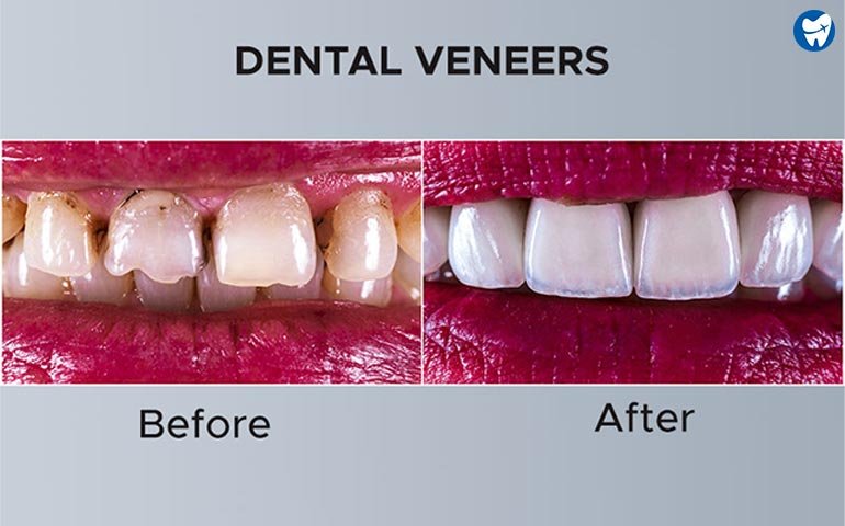 Dental Veneers Abroad: Enhance Your Smile On A Budget