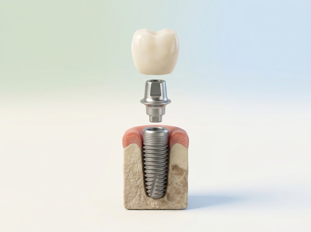 Exploded 3D view of a dental implant: titanium fixture, abutment and zirconia crown