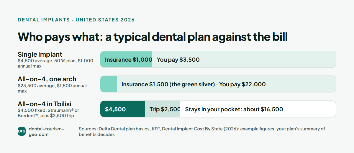 Who pays what for dental implants in the US: insurance share versus what you pay, with Tbilisi for comparison